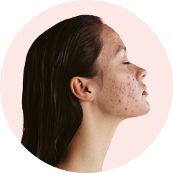 Acne Treatments