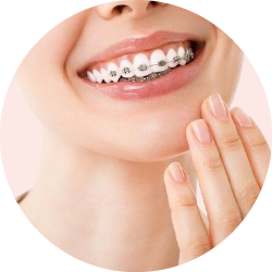 Orthodontic Accessories