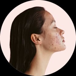 Acne Treatments