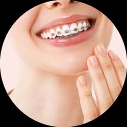 Orthodontic Accessories