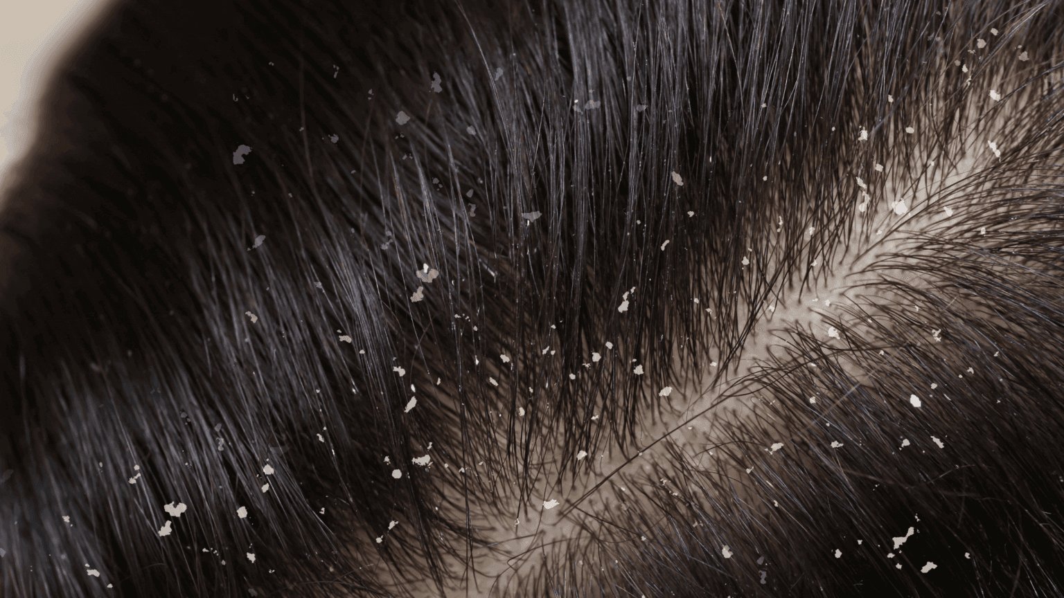 Dandruff in Saudi Arabia: Why It’s So Common & How to Get Rid of It Naturally 2025