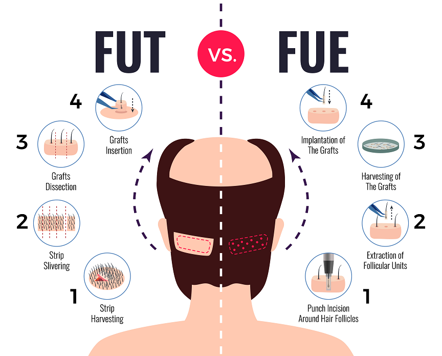 FUE vs FUT scaled 1